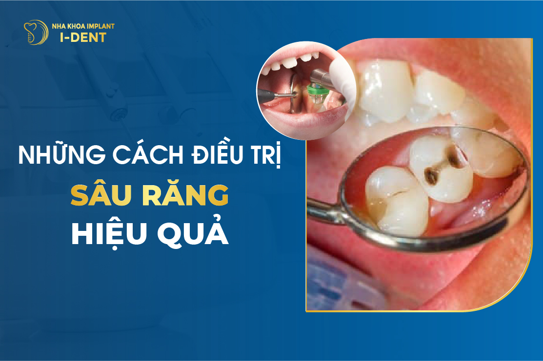 Nhung Cach Dieu Tri Sau Rang Hieu Qua