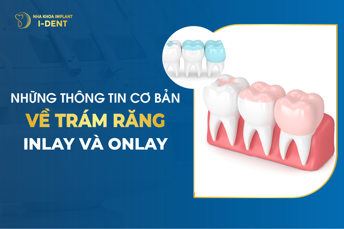 Nhung Thong Tin Co Ban Ve Tram Rang Inlay Va Onlay