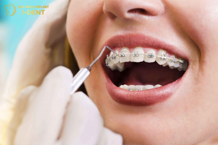Những nha khoa uy tín sẽ đảm bảo quá trình niềng răng diễn ra thuận lợi