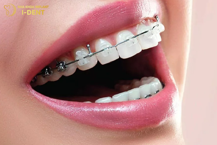 Niềng răng giúp bảo tồn cấu trúc men răng tối đa.