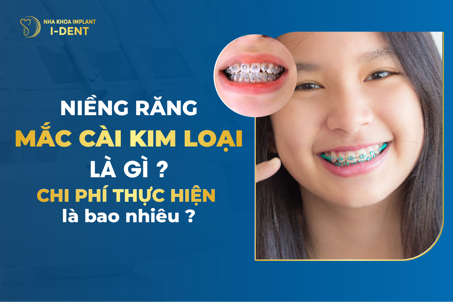 Nieng Rang Mac Cai Kim Loai La Gi