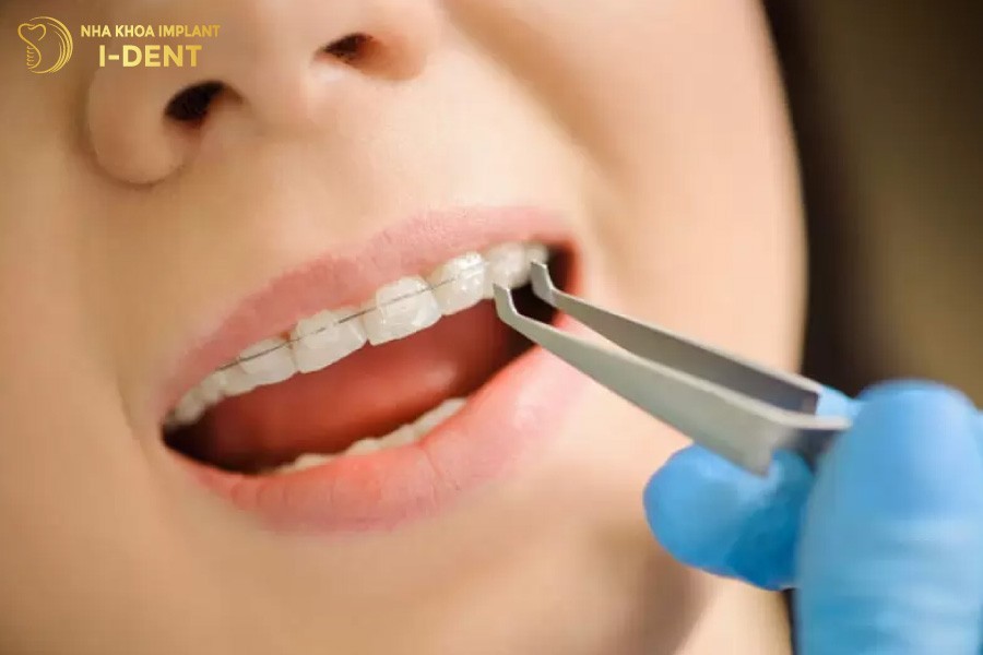 Niềng răng mắc cài pha lê dành cho mọi người