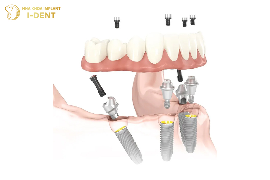 implant all on 4 là gì