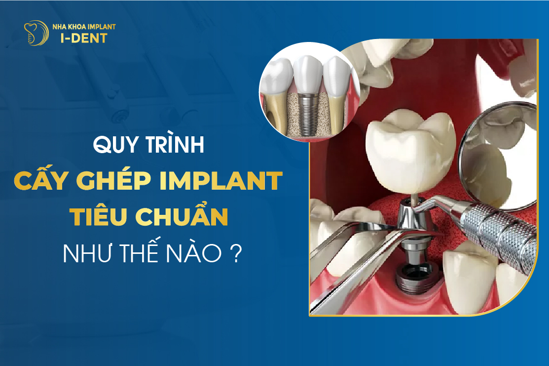 Quy Trinh Cay Ghep Implant Tieu Chuan Nhu The Nao