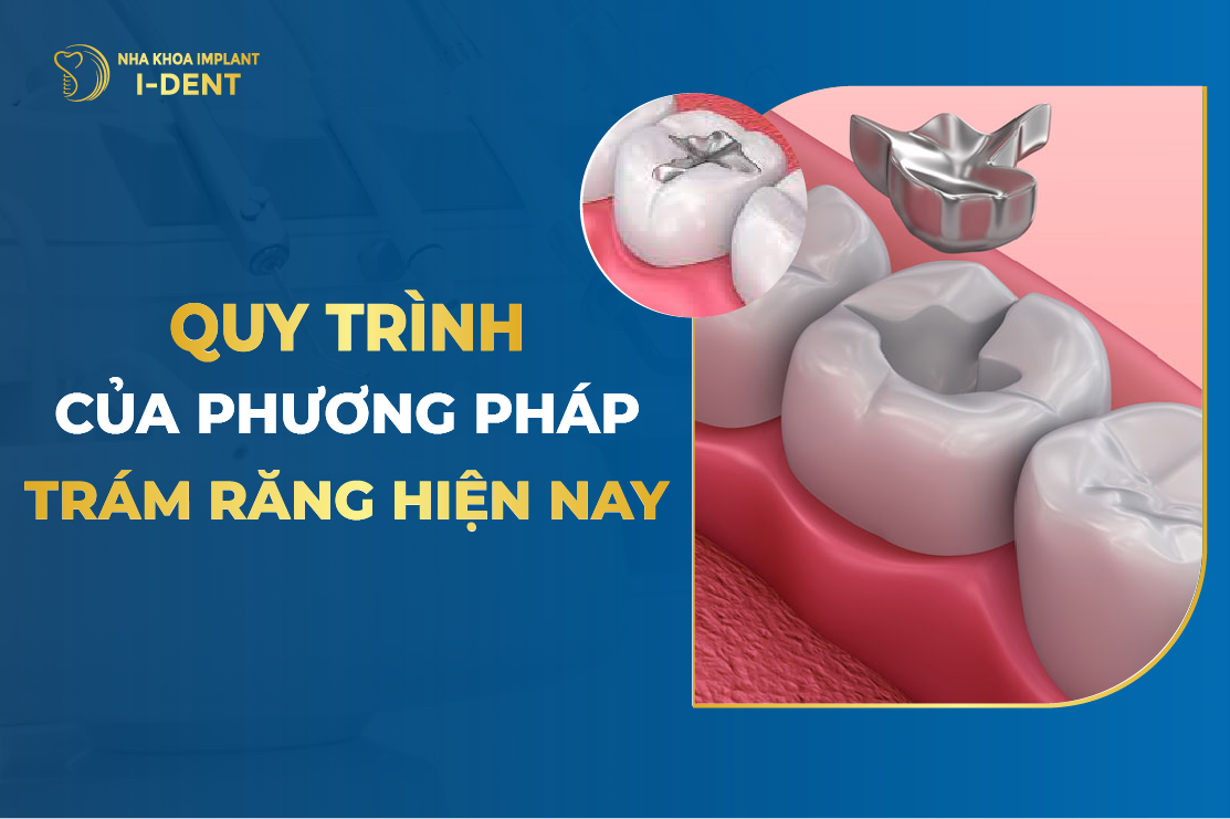 Quy Trinh Cua Phuong Phap Tram Rang Hien Nay