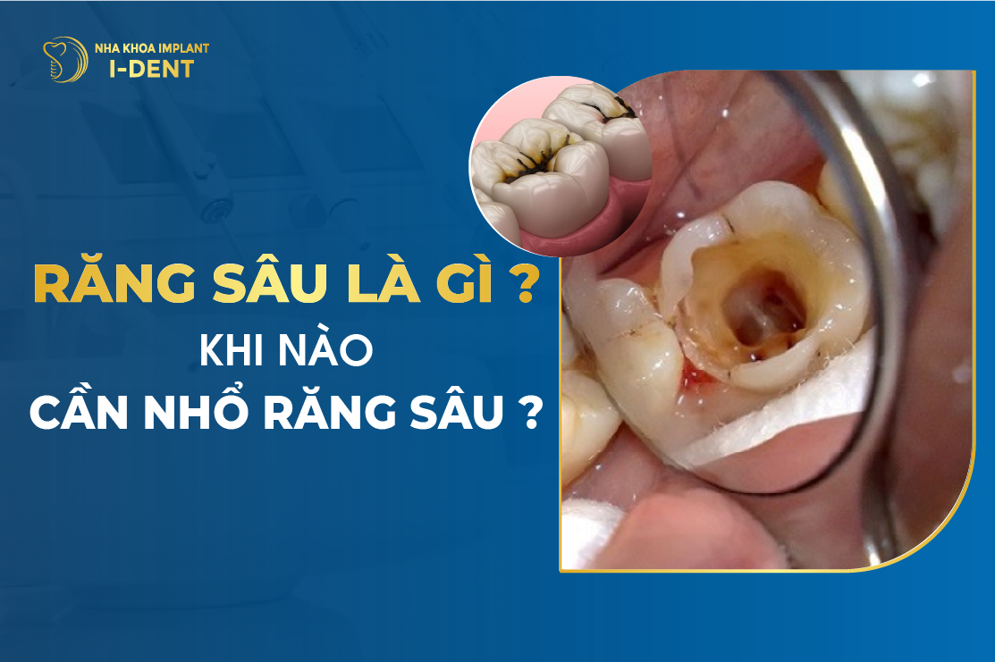 Rang Sau La Gi Khi Nao Can Nho Rang Sau