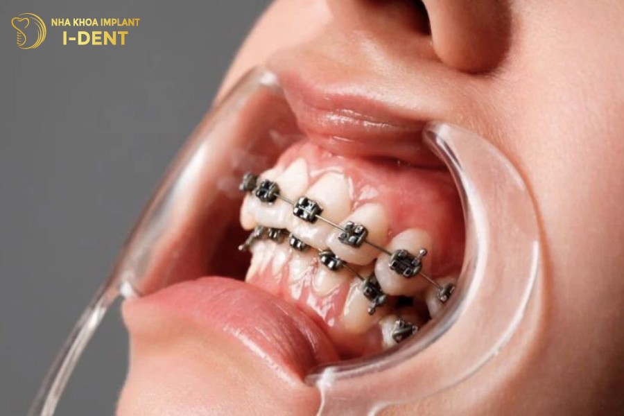 Niềng răng xong vẫn có khả năng bị hô trở lại.
