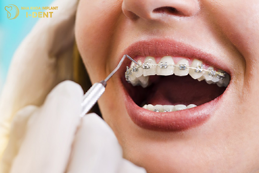 Sai lệch răng càng nặng thì chi phí niềng răng càng cao