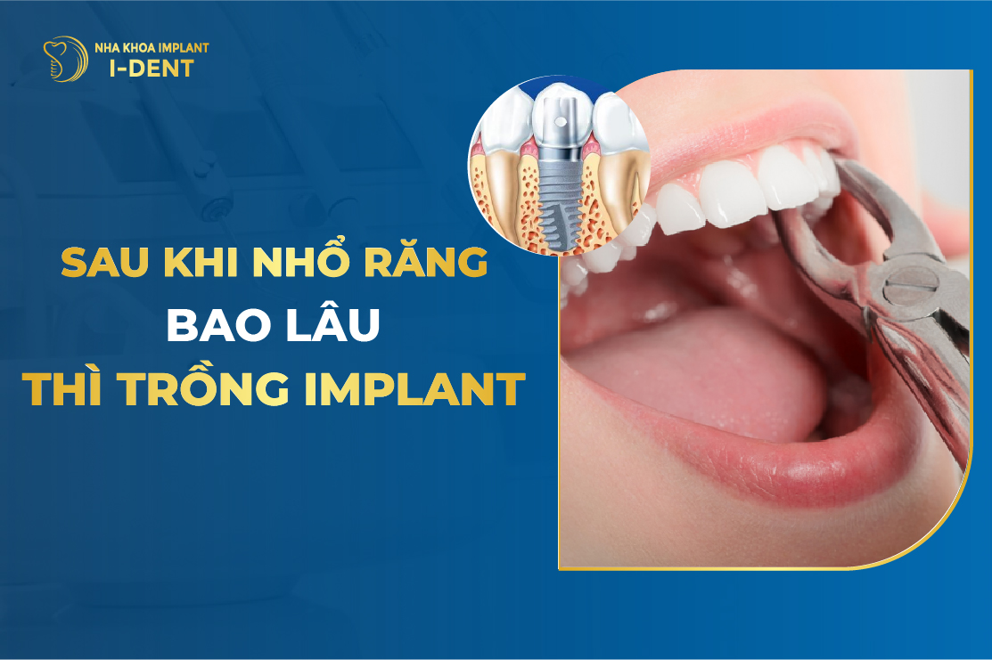 Sau Khi Nho Rang Bao Lau Thi Trong Implant