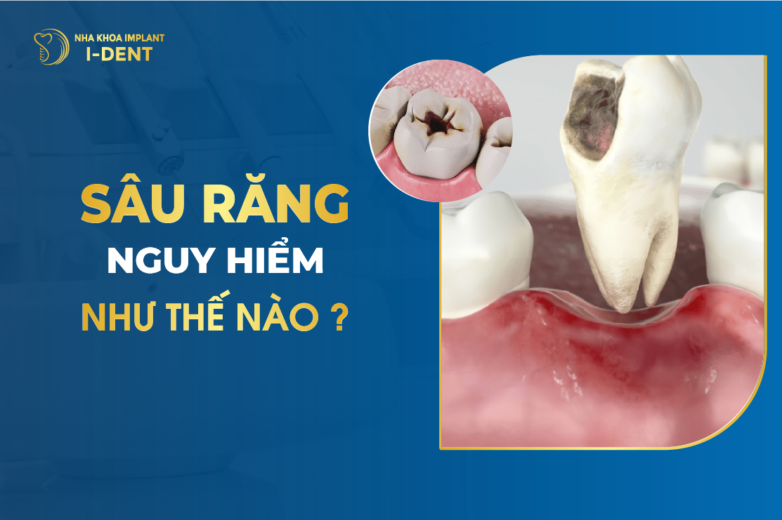 Sau Rang Nguy Hiem Nhu The Nao