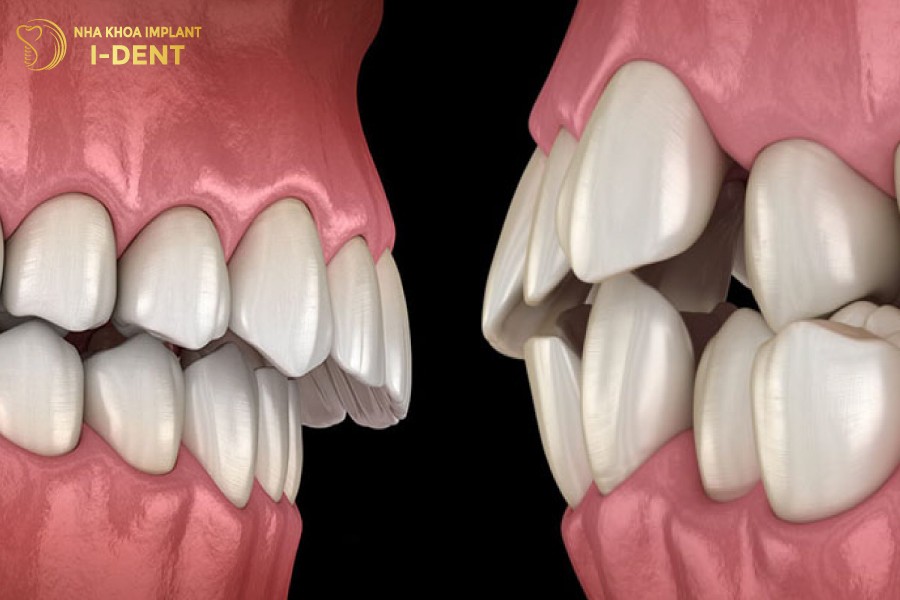 Sự khác biệt giữa hô hàm và hô răng