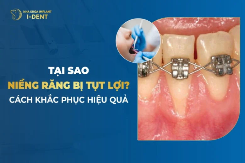 Nguyên Nhân Bị Tụt Lợi Khi Niềng Răng Và Cách Khắc Phục