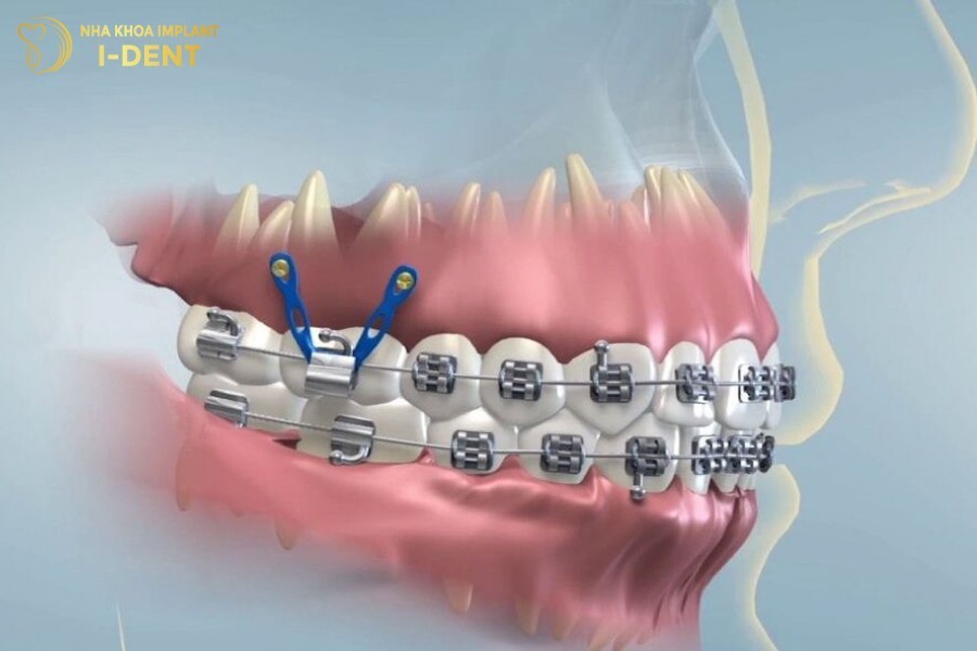 tại sao niềng răng phải bắt vít