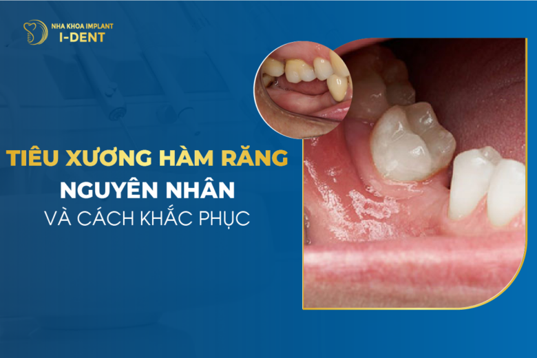 Tiêu Xương Răng Là Gì? Dấu Hiệu, Nguyên Nhân Và Cách Phòng Ngừa