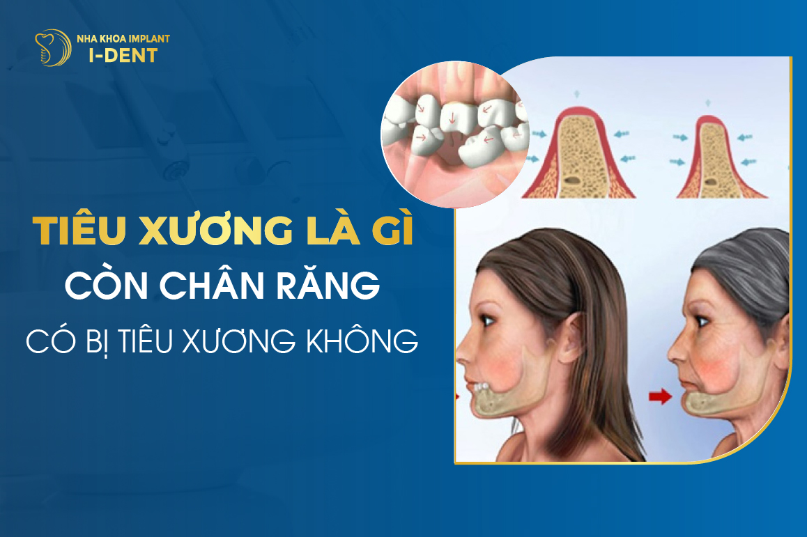 Tieu Xuong La Gi Con Chan Rang Co Bi Tieu Xuong Khong 1