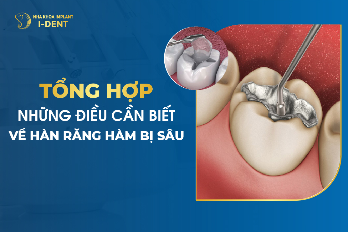 Tong Hop Nhung Dieu Can Biet Ve Han Rang Ham Bi Sau