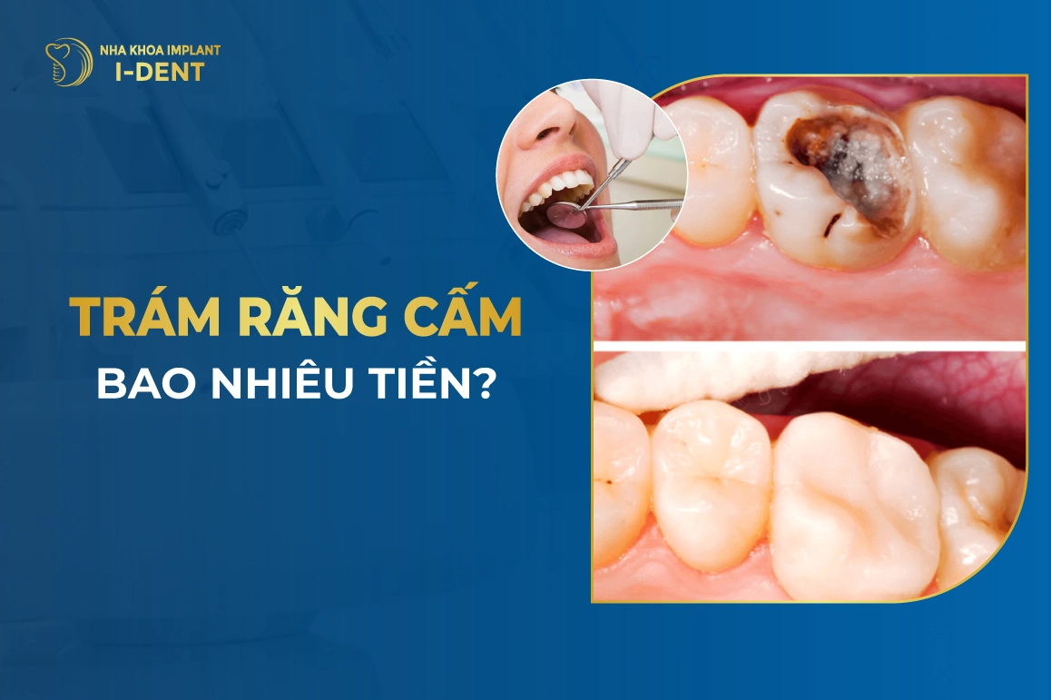 Tram Rang Cam Bao Nhieu Tien