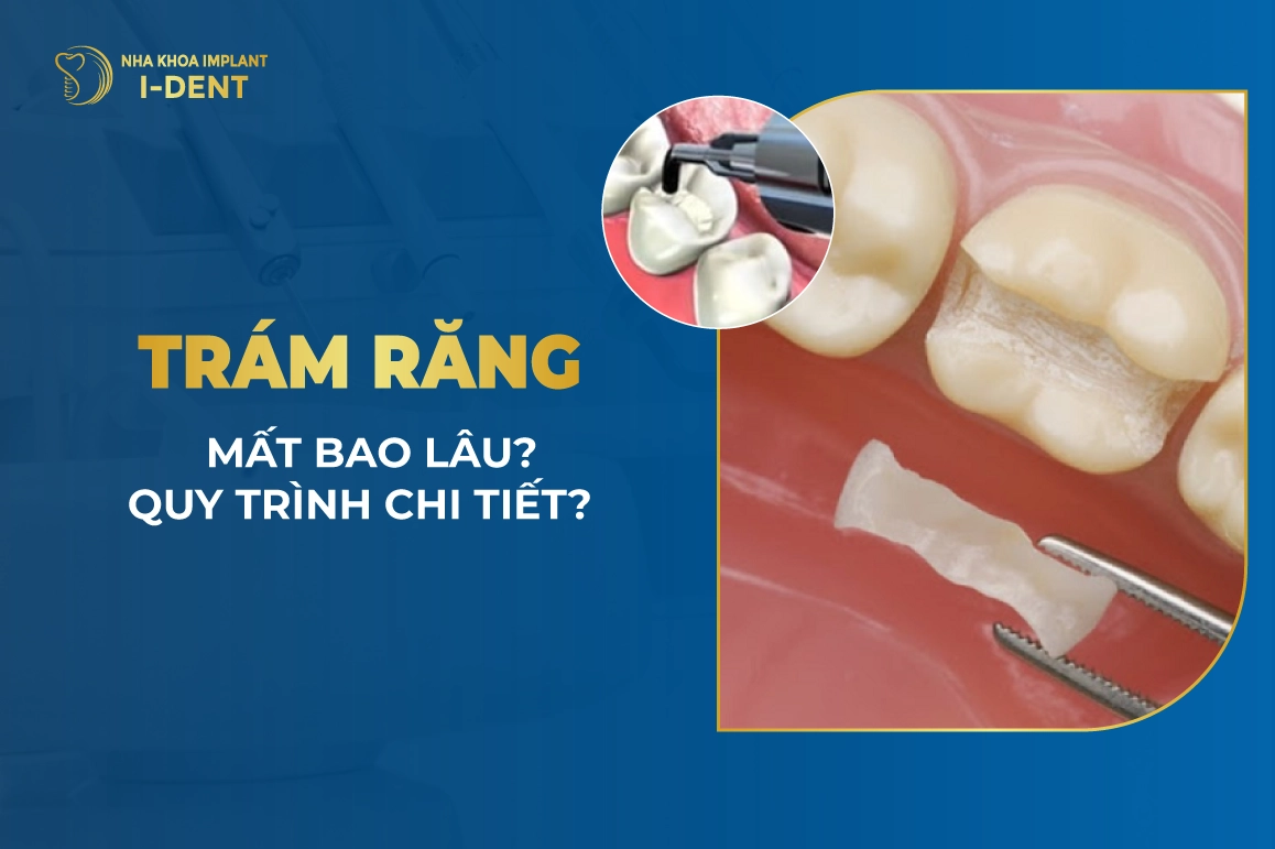 Tram Rang Mat Bao Lau Quy Trinh Chi Tiet