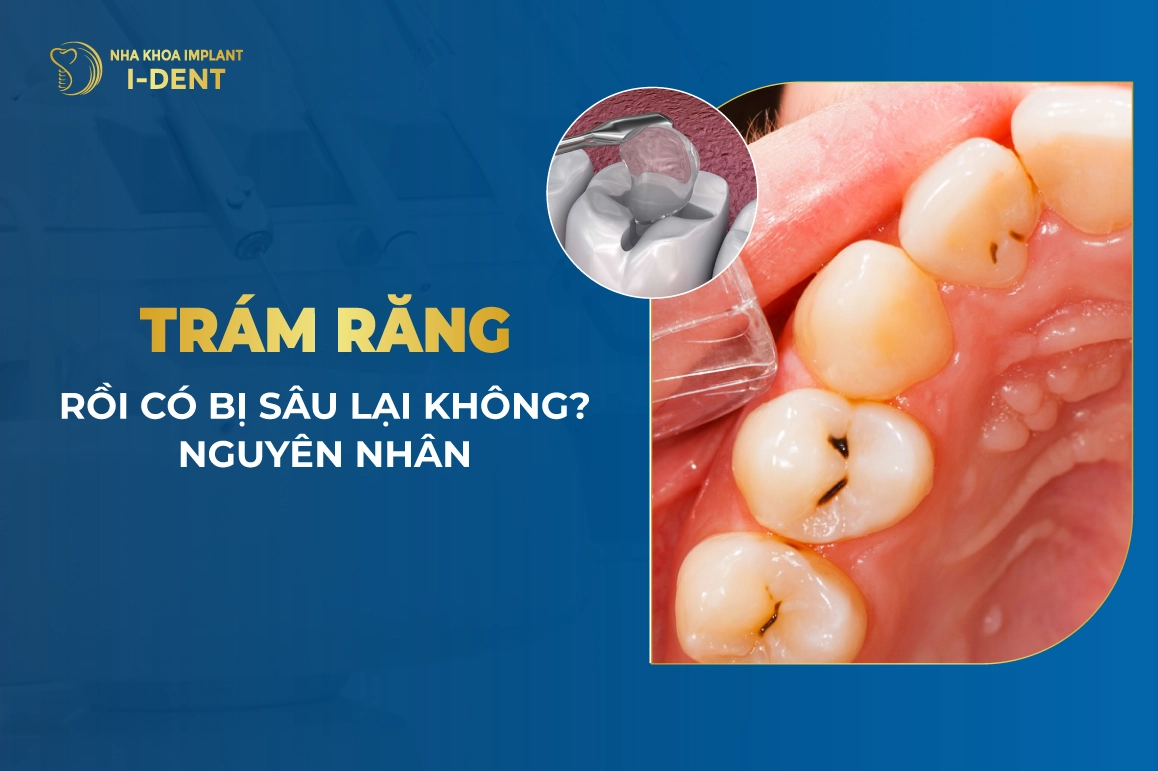 Tram Rang Roi Co Bi Sau Lai Khong Nguyen Nhan