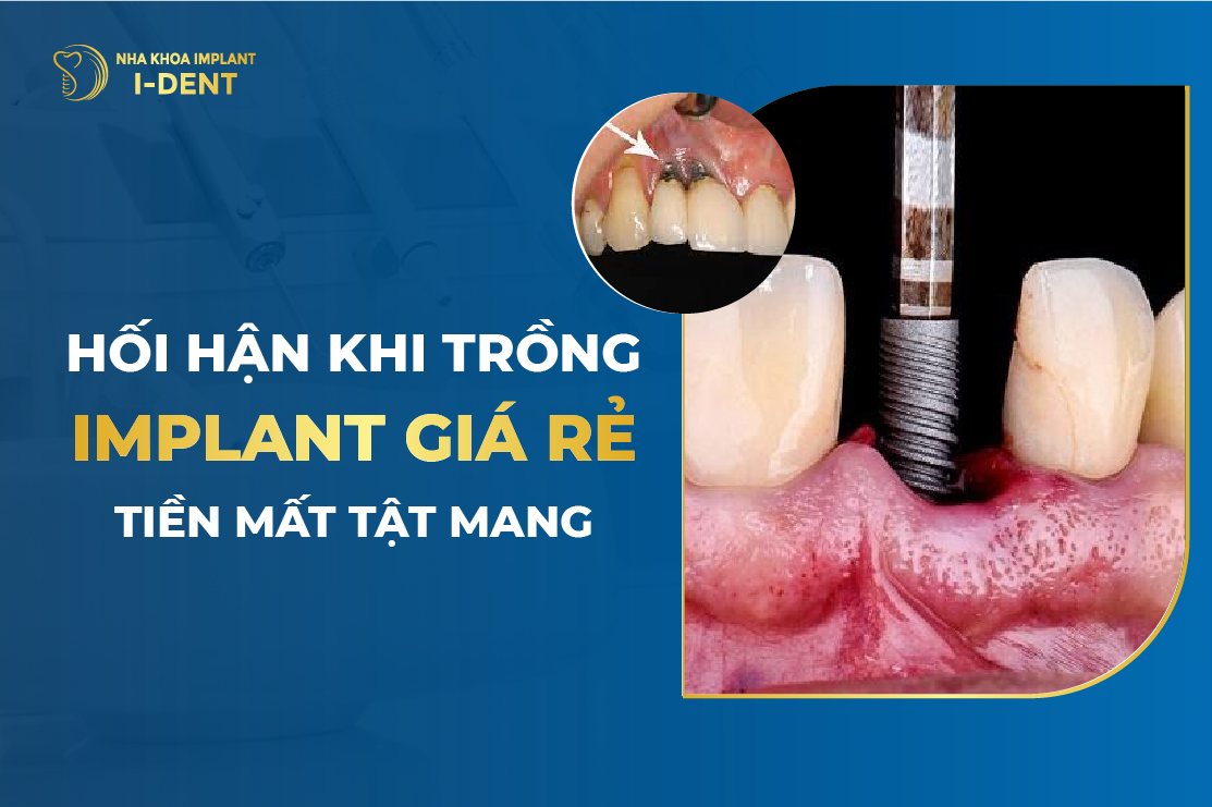 Trong Implant Rang Cua Gia Bao Nhieu Tien Va Mat Bao Lau