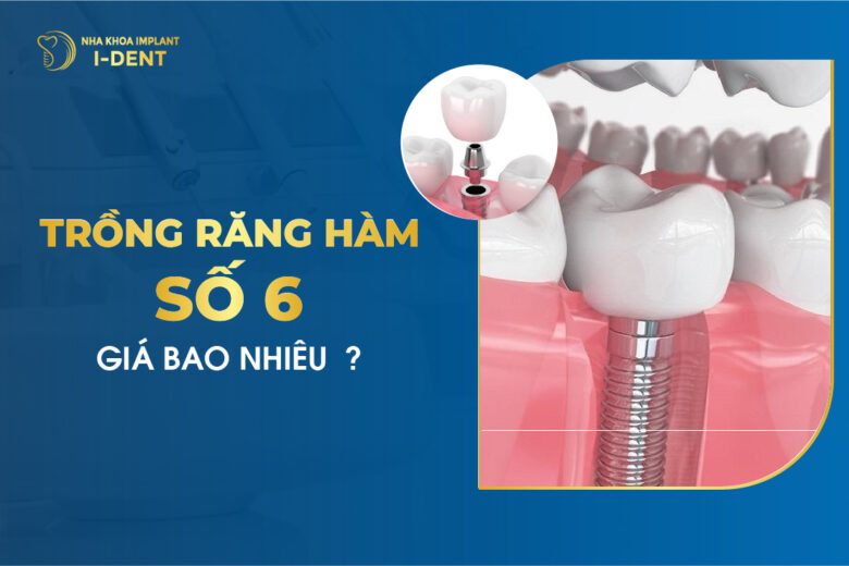 Trồng Răng Hàm Số 6 Giá Bao Nhiêu?