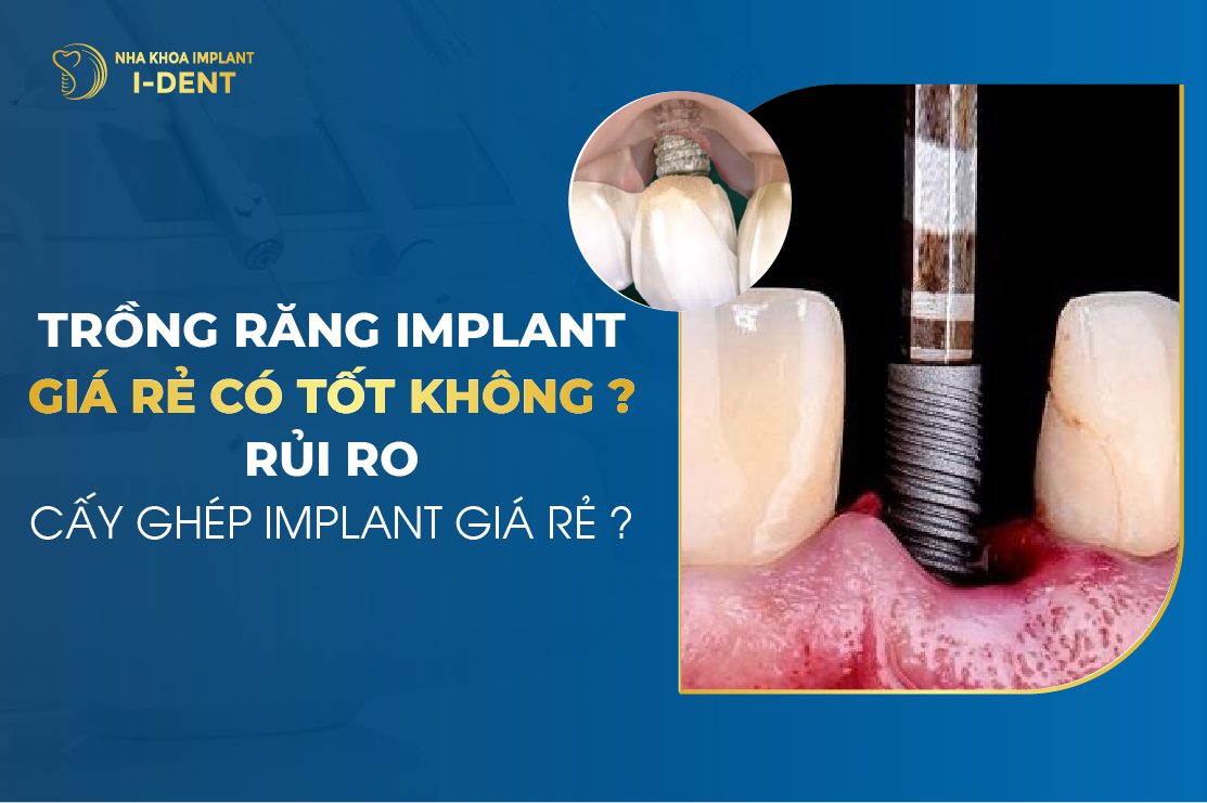 Trong Rang Implant Gia Re Co Tot Khong Rui Ro Cay Ghep Implant Gia Re