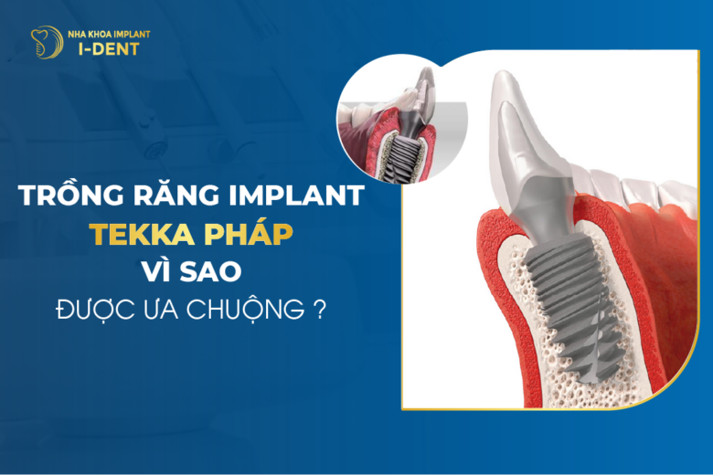 Trụ Implant Tekka Pháp Có Tốt Không? Chi Phí Bao Nhiêu?