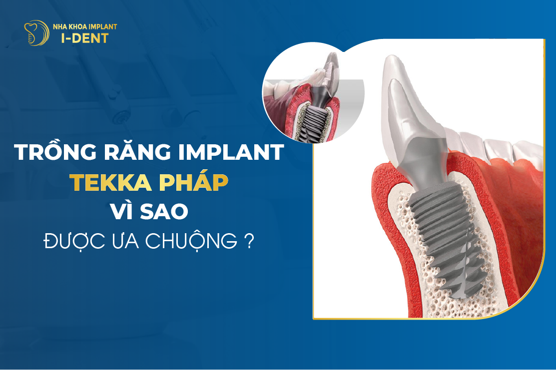 Trong Rang Implant Tekka Phap Vi Sao Duoc Ua Chuong