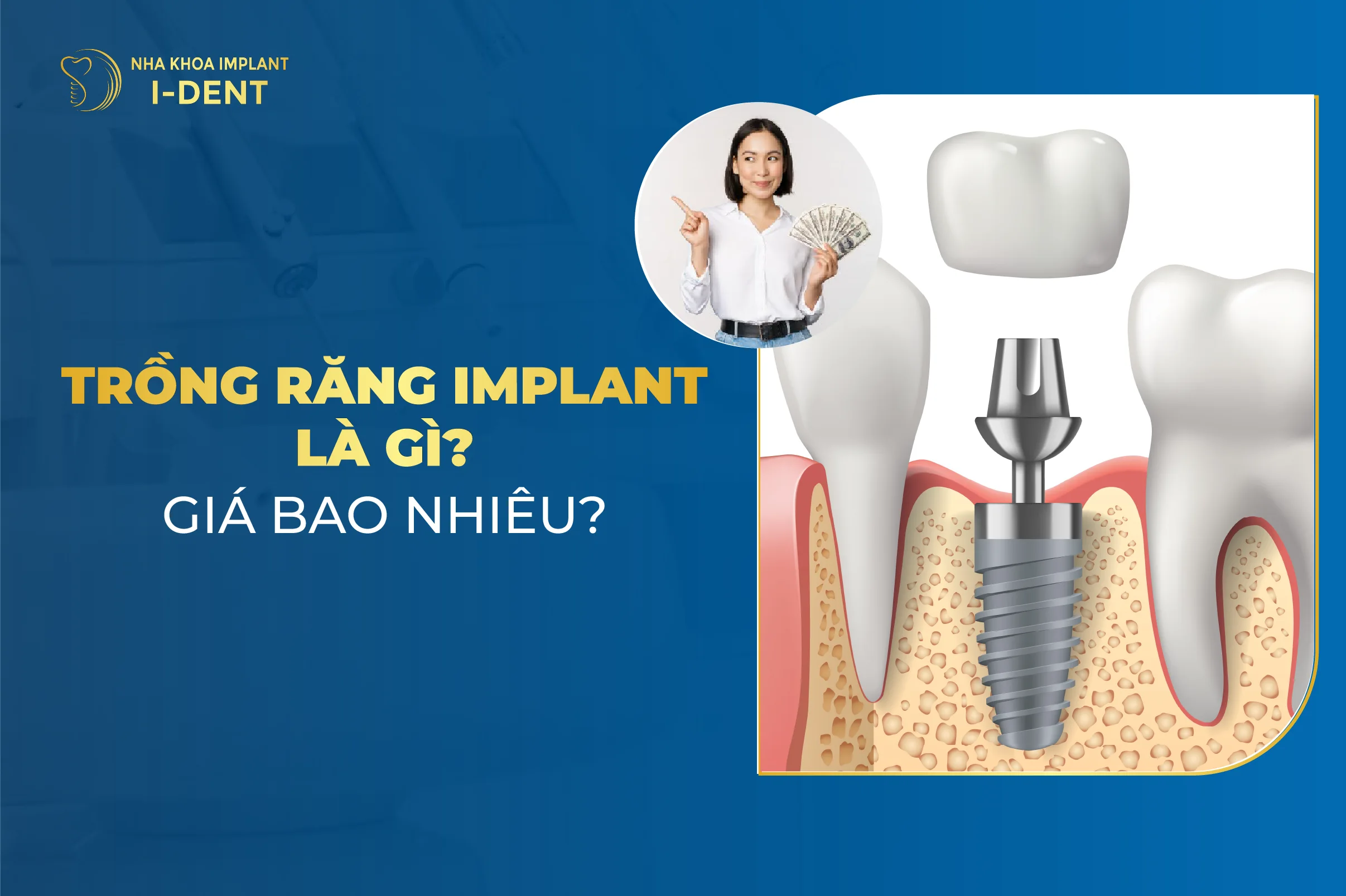Trong Rang Implant La Gi Gia Bao Nhieu