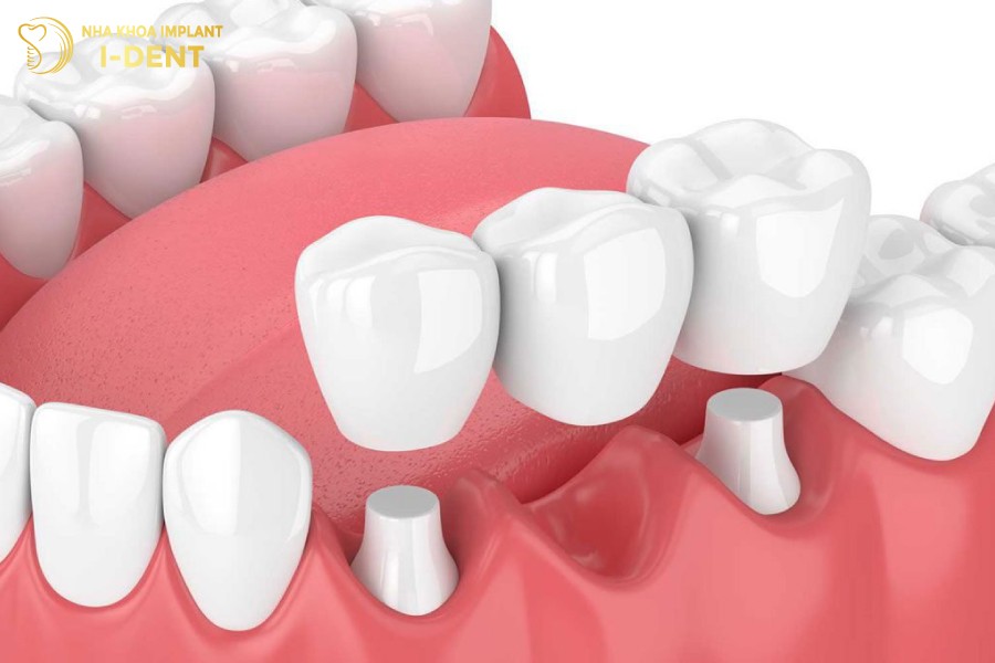 trồng răng bắc cầu