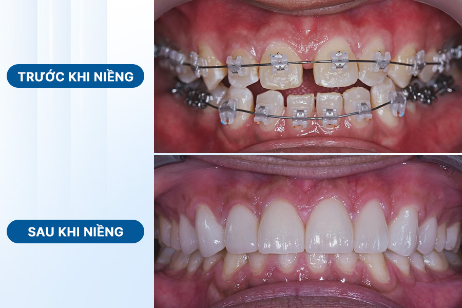 ảnh niềng răng