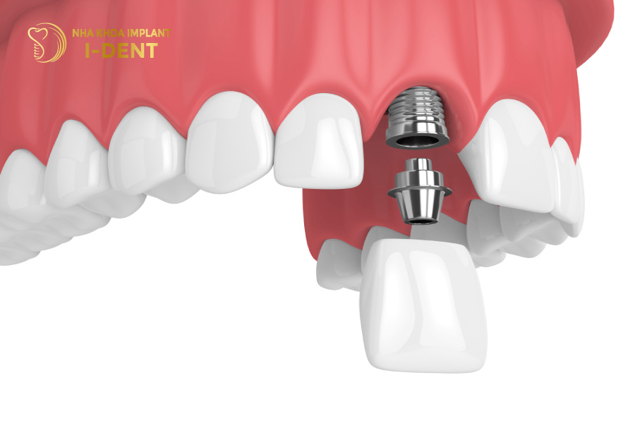 Biện pháp phục hình răng cửa đã mất