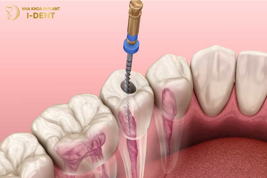 lấy tủy bọc răng sứ giá bao nhiêu