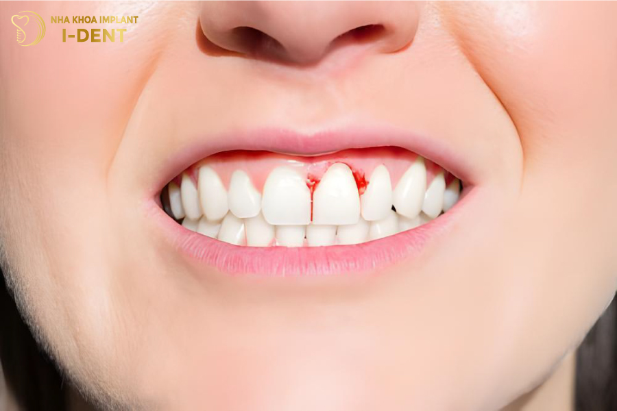 Viêm lợi kéo dài gây ê buốt