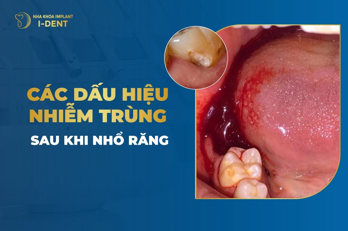 Cac Dau Hieu Nhiem Trung Sau Khi Nho Rang