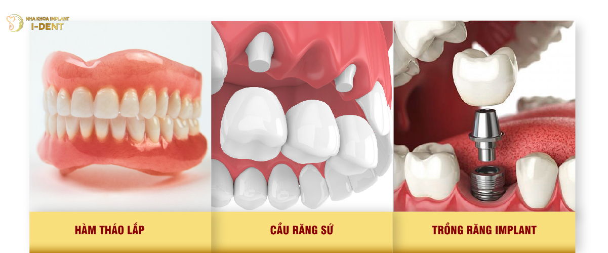 phương pháp trồng răng