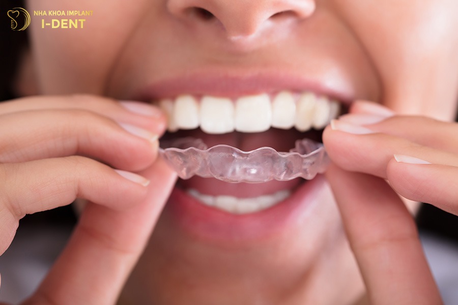 Nên dùng máng bảo vệ răng để bảo vệ răng sứ