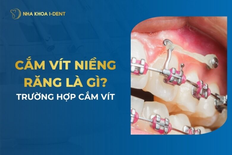 Cắm Vít Niềng Răng: Tác Dụng, Trường Hợp Và Quy Trình