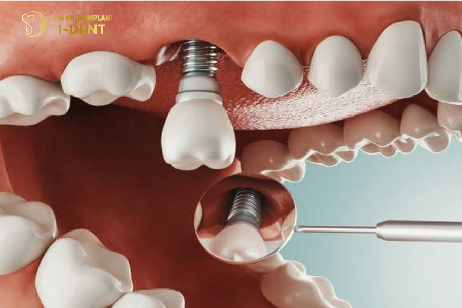 răng cấm có trồng được không