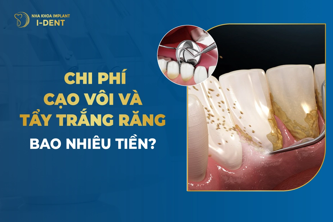 Cao Voi Rang Va Tay Trang Rang Bao Nhieu Tien