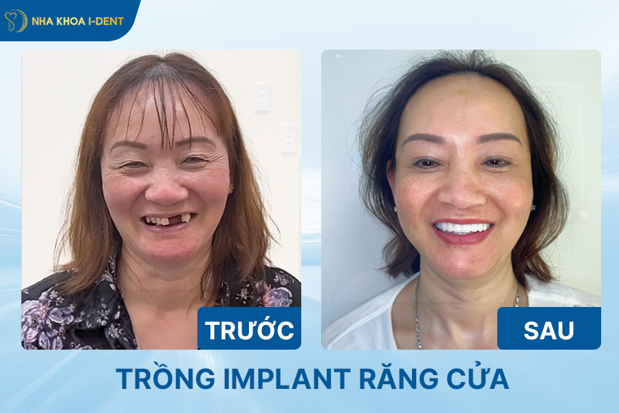 Cấy implant răng cửa