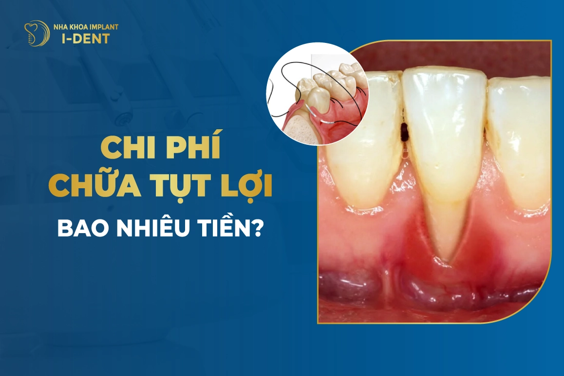 Chi Phi Chua Tut Loi Bao Nhieu Tien