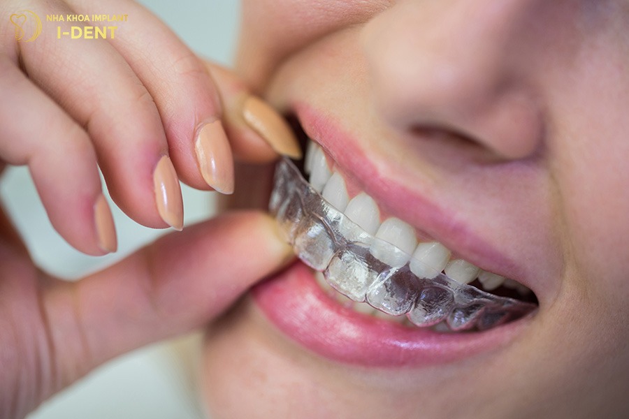 tác hại của niềng răng