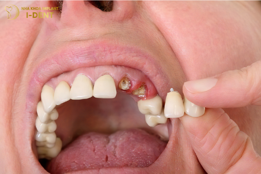 Cùi giả có thể bị gãy nếu ăn thức ăn quá cứng