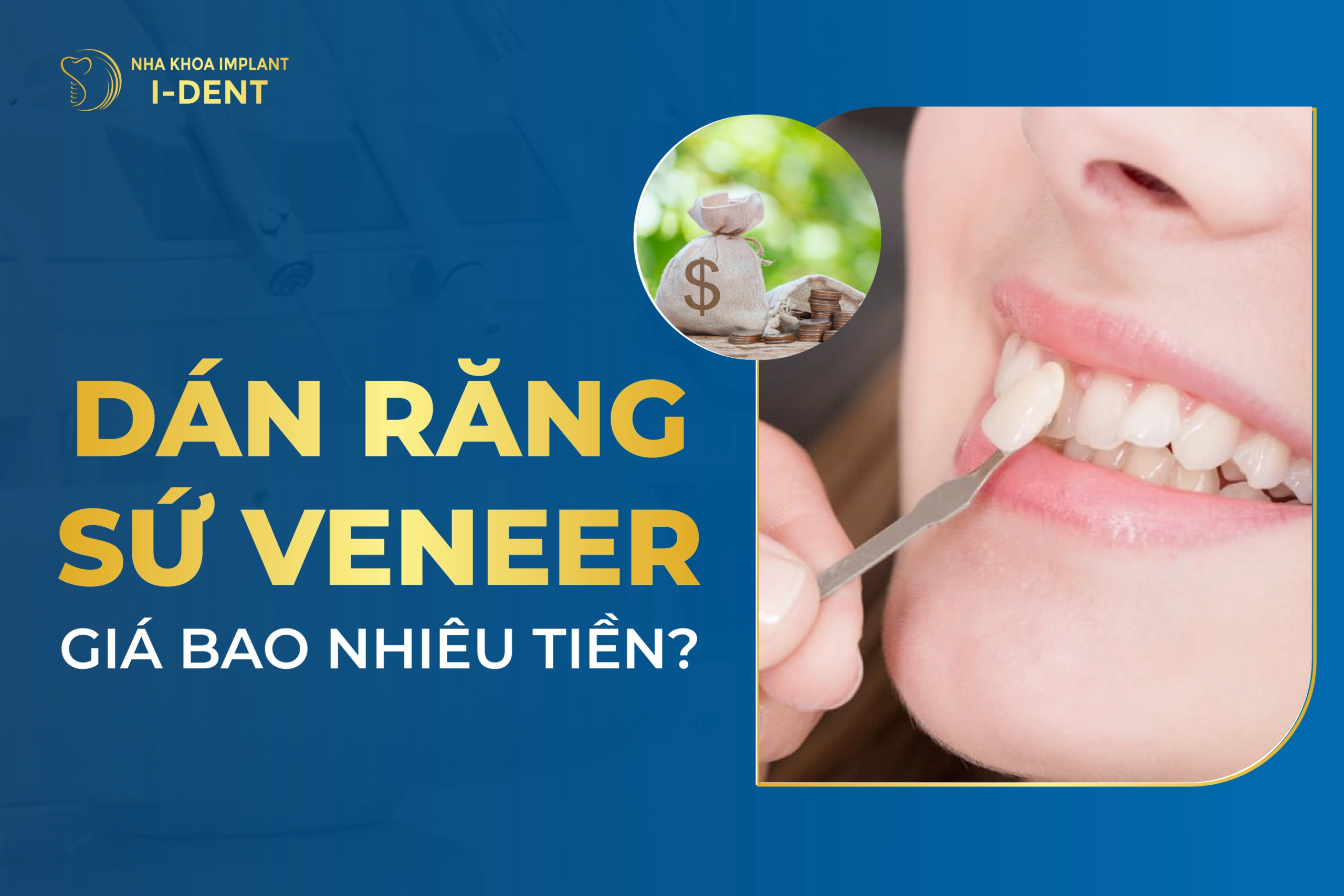 Dan Rang Su Veneer Gia Bao Nhieu Scaled