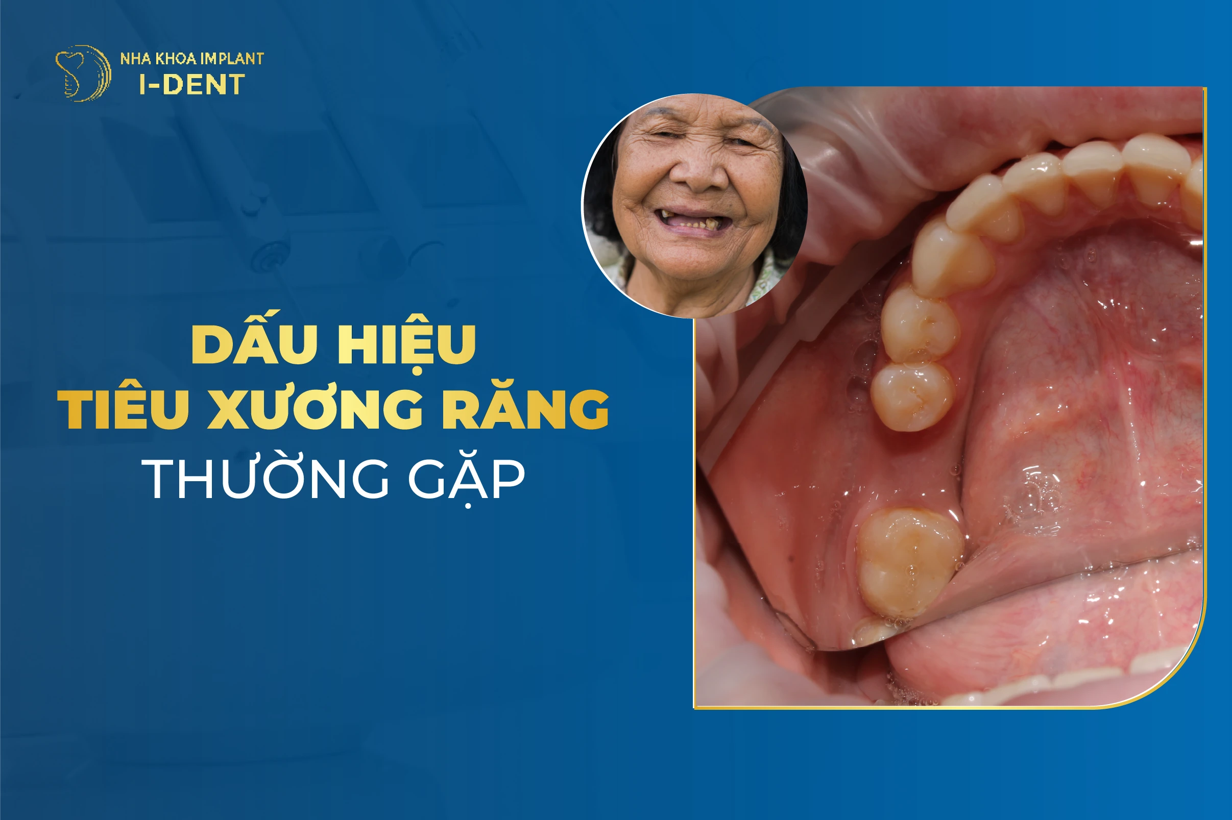 Dau Hieu Tieu Xuong Rang