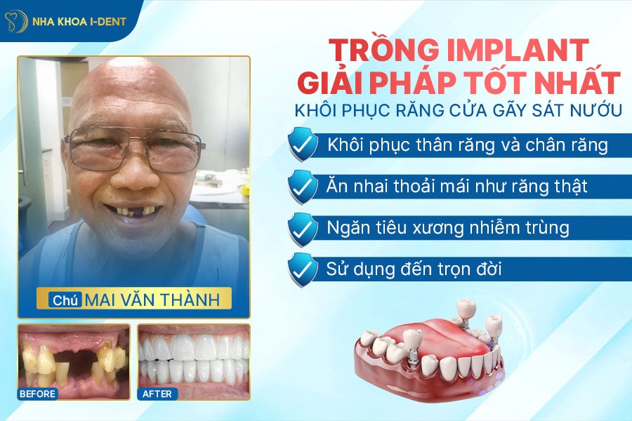 gãy răng cửa