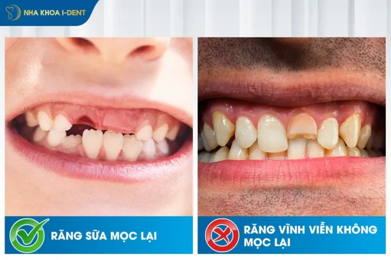 Gãy Răng Cửa Có Mọc Lại Không? Cách Khắc Phục