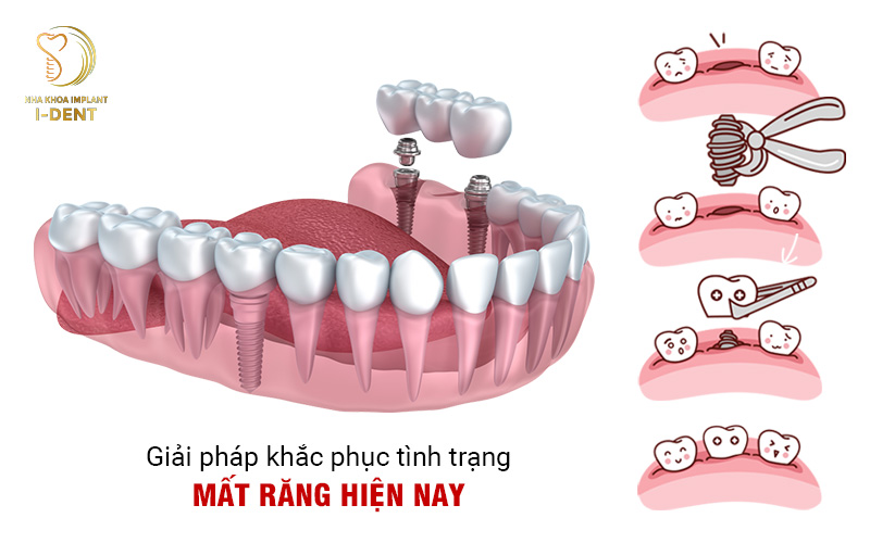nên làm cầu răng hay implant