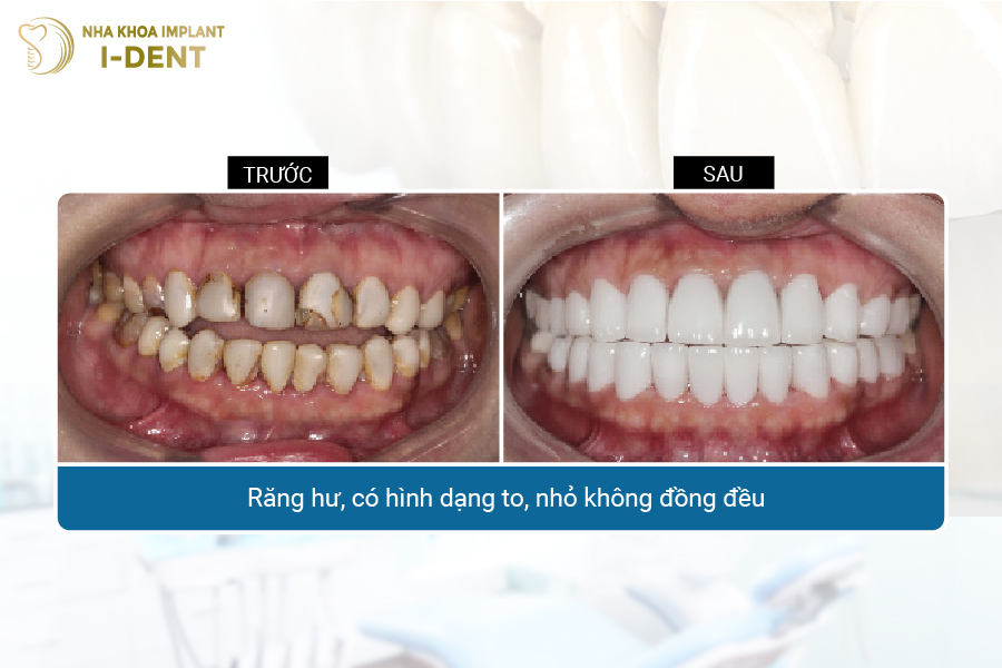bọc răng sứ